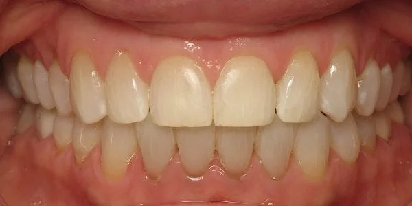 invisalign-after-images-600x300-1