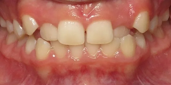 invisalign-before-pictures-600x300-1